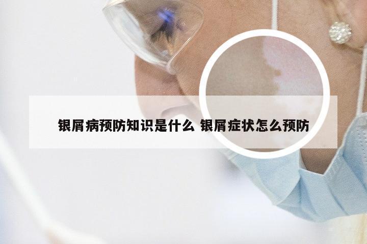 银屑病预防知识是什么 银屑症状怎么预防