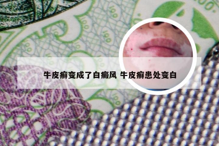 牛皮癣变成了白癜风 牛皮癣患处变白