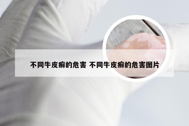 不同牛皮癣的危害 不同牛皮癣的危害图片