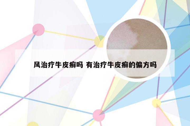 风治疗牛皮癣吗 有治疗牛皮癣的偏方吗