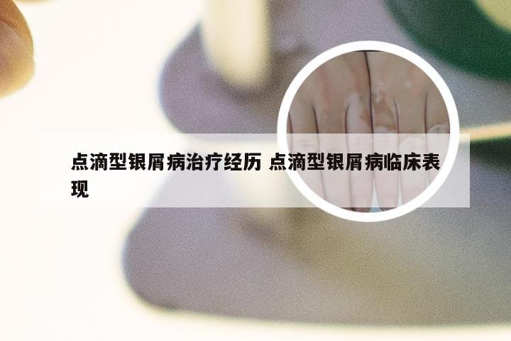 点滴型银屑病治疗经历 点滴型银屑病临床表现