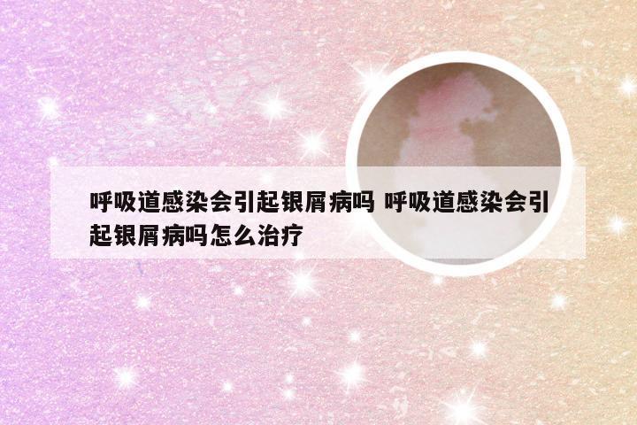 呼吸道感染会引起银屑病吗 呼吸道感染会引起银屑病吗怎么治疗