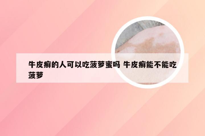 牛皮癣的人可以吃菠萝蜜吗 牛皮癣能不能吃菠萝