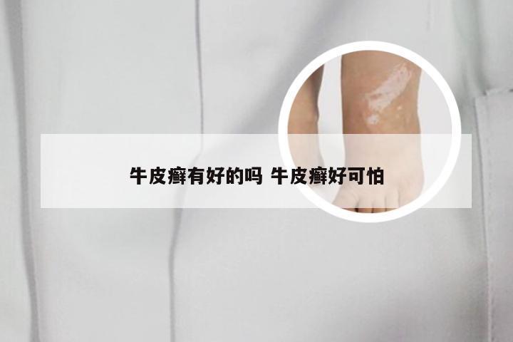 牛皮癣有好的吗 牛皮癣好可怕