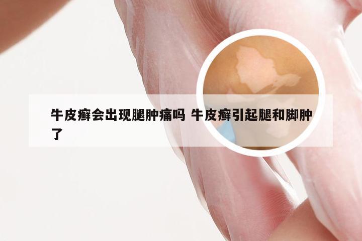 牛皮癣会出现腿肿痛吗 牛皮癣引起腿和脚肿了