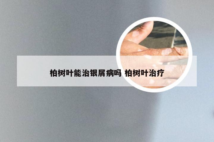 柏树叶能治银屑病吗 柏树叶治疗