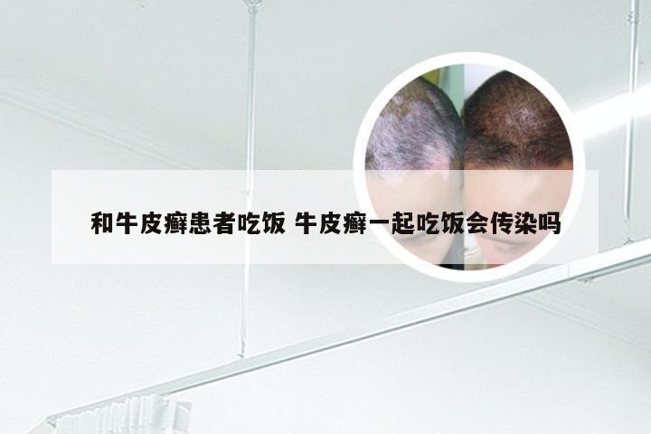 和牛皮癣患者吃饭 牛皮癣一起吃饭会传染吗