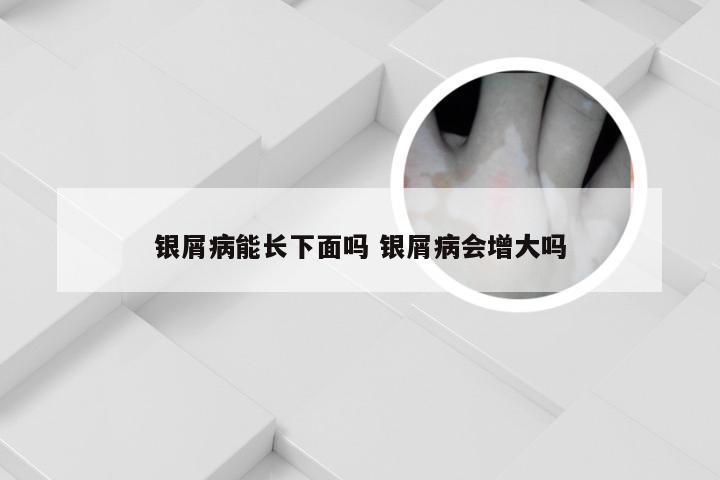 银屑病能长下面吗 银屑病会增大吗