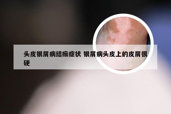 头皮银屑病结痂症状 银屑病头皮上的皮屑很硬
