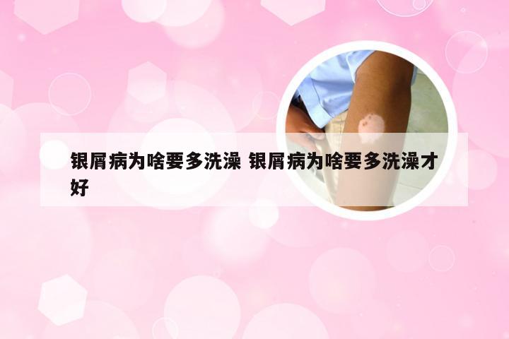 银屑病为啥要多洗澡 银屑病为啥要多洗澡才好