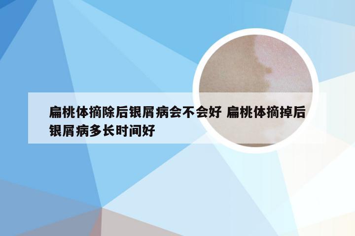 扁桃体摘除后银屑病会不会好 扁桃体摘掉后银屑病多长时间好