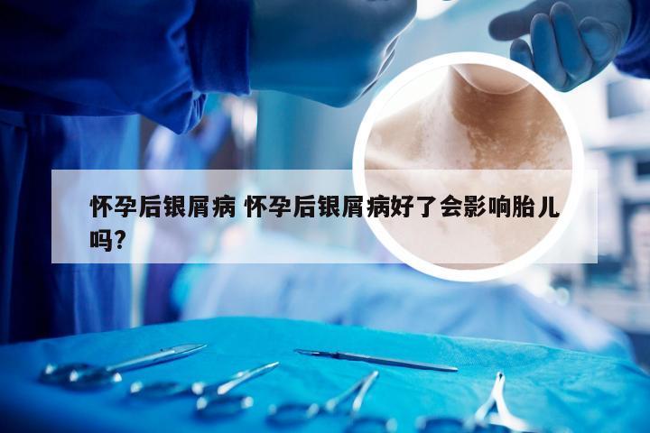 怀孕后银屑病 怀孕后银屑病好了会影响胎儿吗?