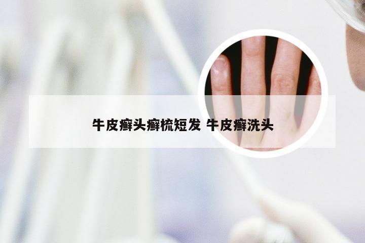 牛皮癣头癣梳短发 牛皮癣洗头