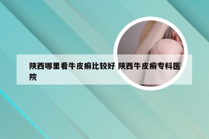 陕西哪里看牛皮癣比较好 陕西牛皮癣专科医院