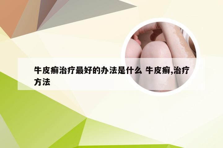 牛皮癣治疗最好的办法是什么 牛皮癣,治疗方法