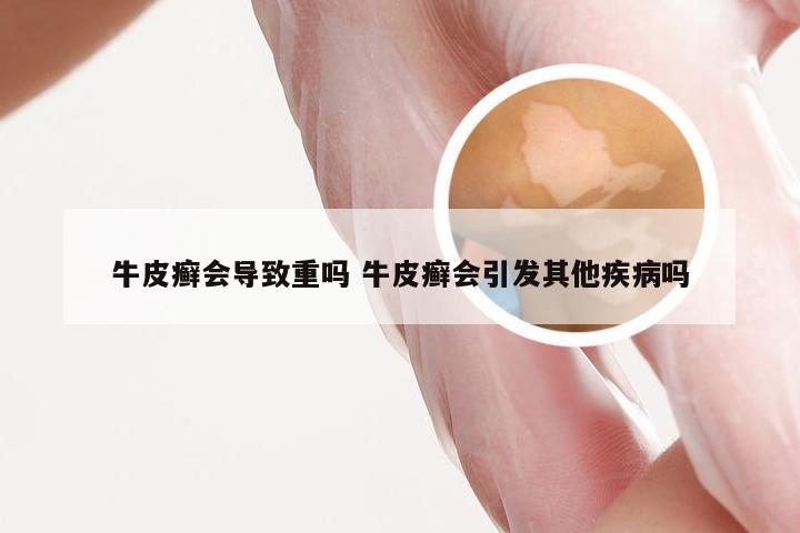 牛皮癣会导致重吗 牛皮癣会引发其他疾病吗