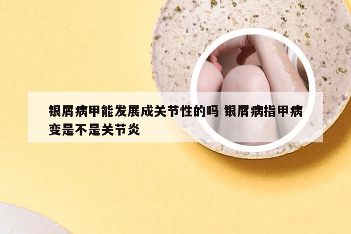 银屑病甲能发展成关节性的吗 银屑病指甲病变是不是关节炎