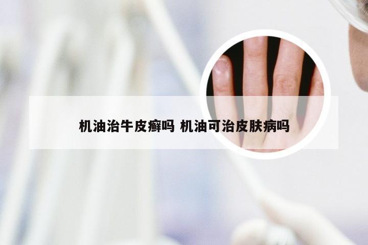 机油治牛皮癣吗 机油可治皮肤病吗