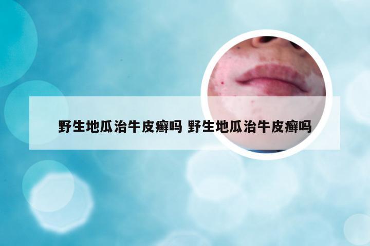 野生地瓜治牛皮癣吗 野生地瓜治牛皮癣吗