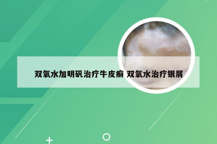 双氧水加明矾治疗牛皮癣 双氧水治疗银屑