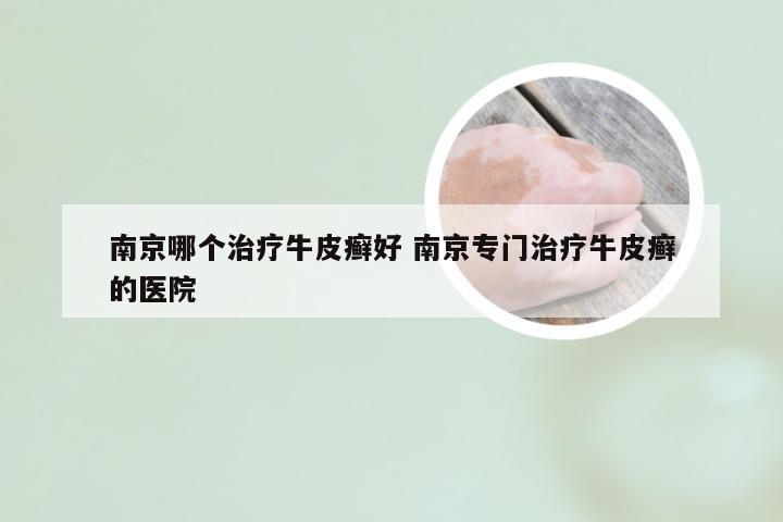 南京哪个治疗牛皮癣好 南京专门治疗牛皮癣的医院