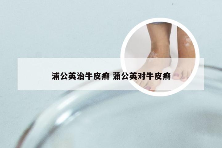 浦公英治牛皮癣 蒲公英对牛皮癣