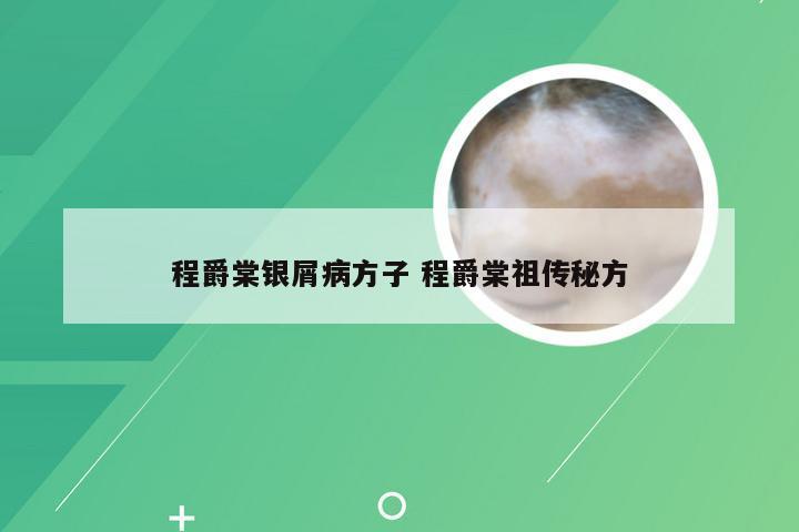 程爵棠银屑病方子 程爵棠祖传秘方