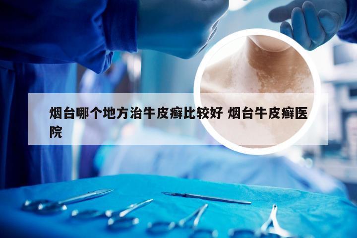 烟台哪个地方治牛皮癣比较好 烟台牛皮癣医院