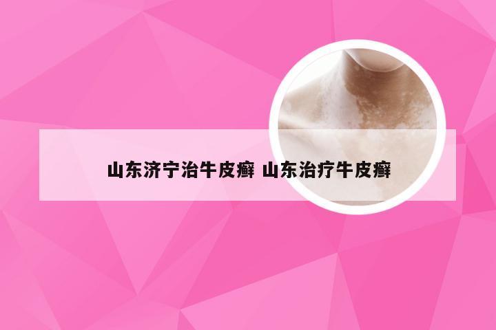 山东济宁治牛皮癣 山东治疗牛皮癣