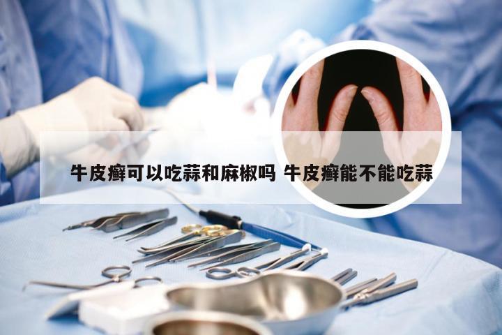 牛皮癣可以吃蒜和麻椒吗 牛皮癣能不能吃蒜