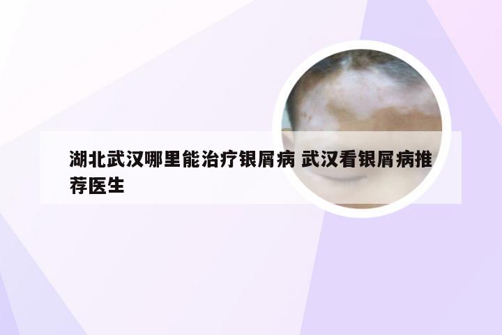湖北武汉哪里能治疗银屑病 武汉看银屑病推荐医生