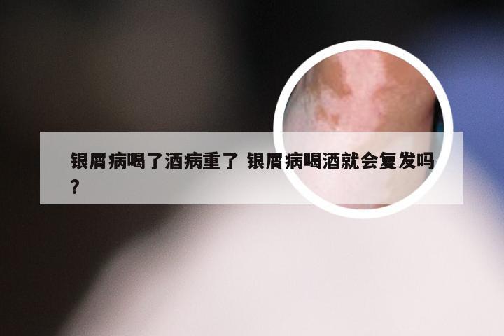 银屑病喝了酒病重了 银屑病喝酒就会复发吗?