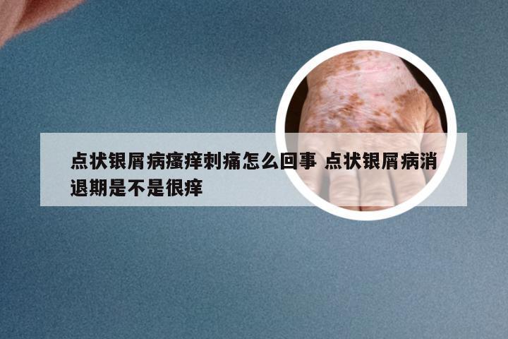 点状银屑病瘙痒刺痛怎么回事 点状银屑病消退期是不是很痒