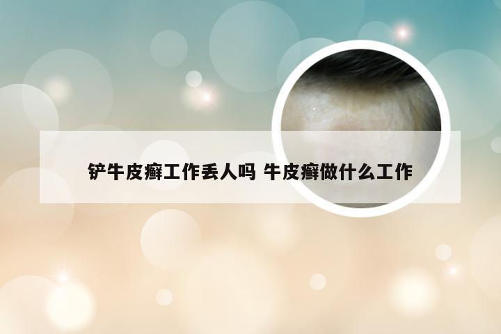 铲牛皮癣工作丢人吗 牛皮癣做什么工作