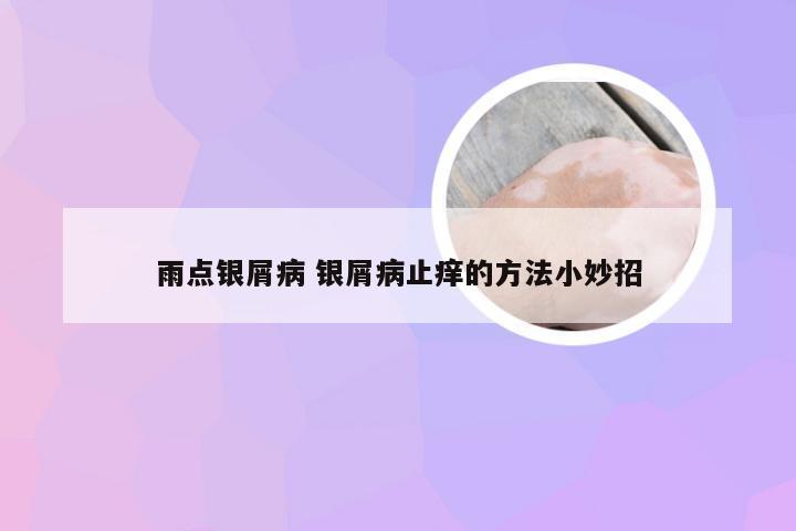 雨点银屑病 银屑病止痒的方法小妙招