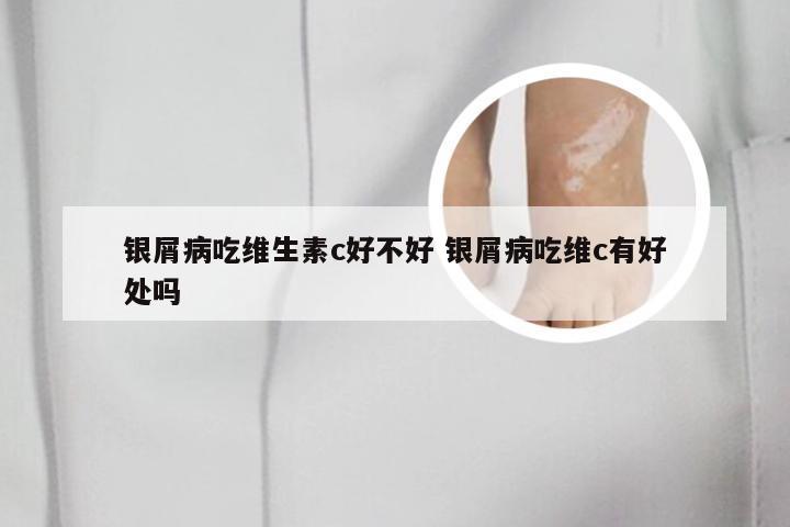 银屑病吃维生素c好不好 银屑病吃维c有好处吗
