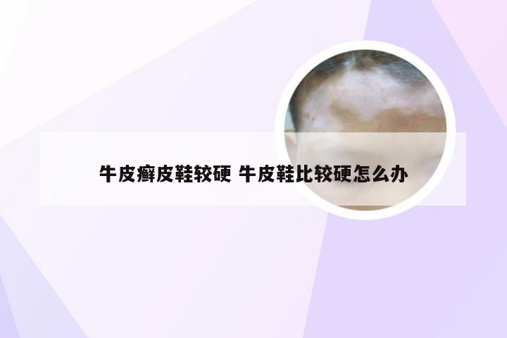 牛皮癣皮鞋较硬 牛皮鞋比较硬怎么办