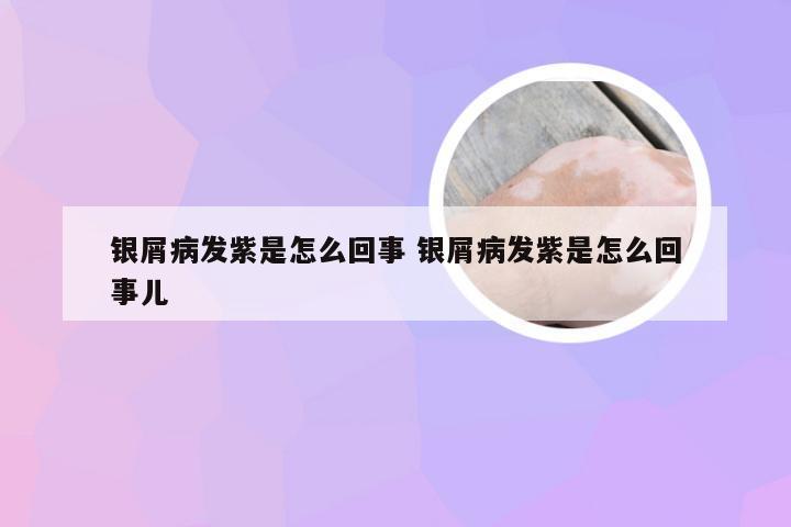 银屑病发紫是怎么回事 银屑病发紫是怎么回事儿