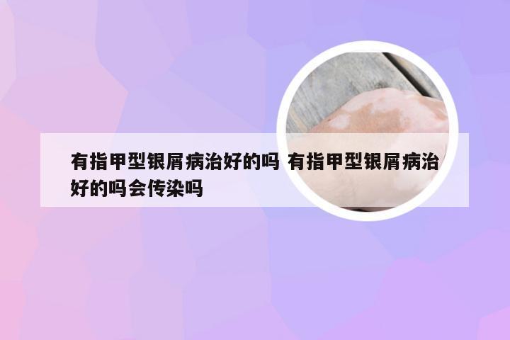 有指甲型银屑病治好的吗 有指甲型银屑病治好的吗会传染吗