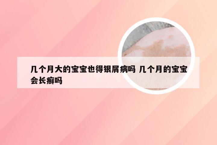 几个月大的宝宝也得银屑病吗 几个月的宝宝会长癣吗