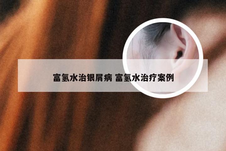 富氢水治银屑病 富氢水治疗案例