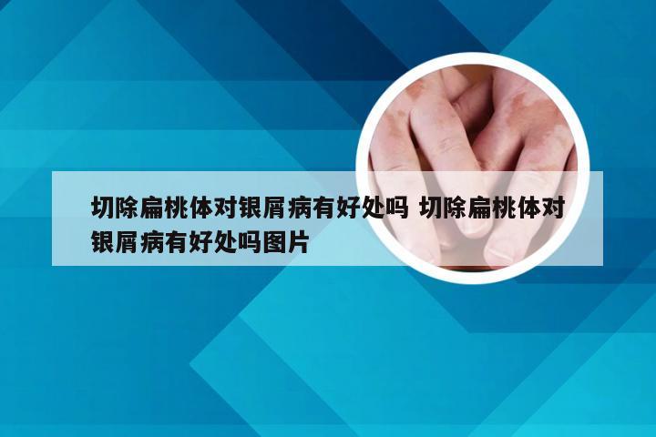 切除扁桃体对银屑病有好处吗 切除扁桃体对银屑病有好处吗图片