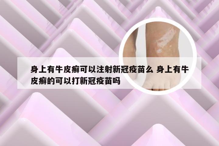 身上有牛皮癣可以注射新冠疫苗么 身上有牛皮癣的可以打新冠疫苗吗