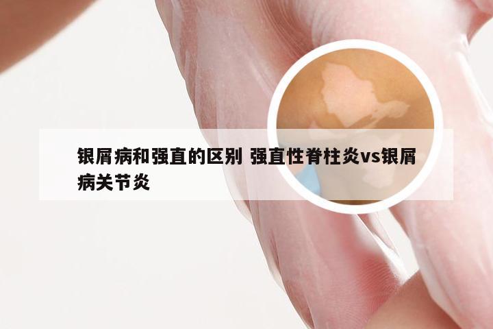 银屑病和强直的区别 强直性脊柱炎vs银屑病关节炎