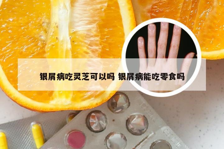 银屑病吃灵芝可以吗 银屑病能吃零食吗