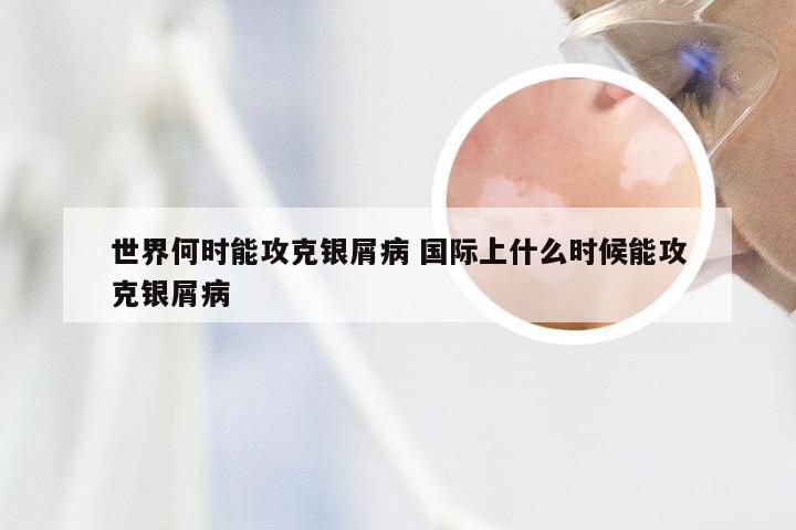 世界何时能攻克银屑病 国际上什么时候能攻克银屑病