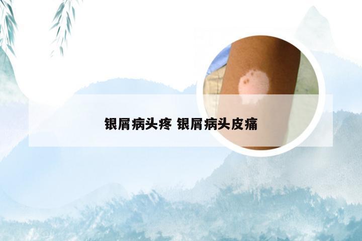 银屑病头疼 银屑病头皮痛