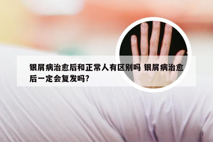 银屑病治愈后和正常人有区别吗 银屑病治愈后一定会复发吗?