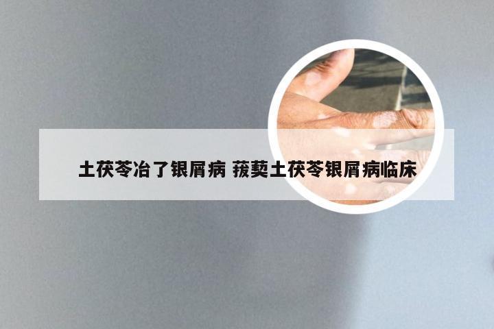 土茯苓冶了银屑病 菝葜土茯苓银屑病临床