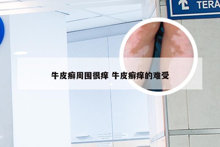 牛皮癣周围很痒 牛皮癣痒的难受